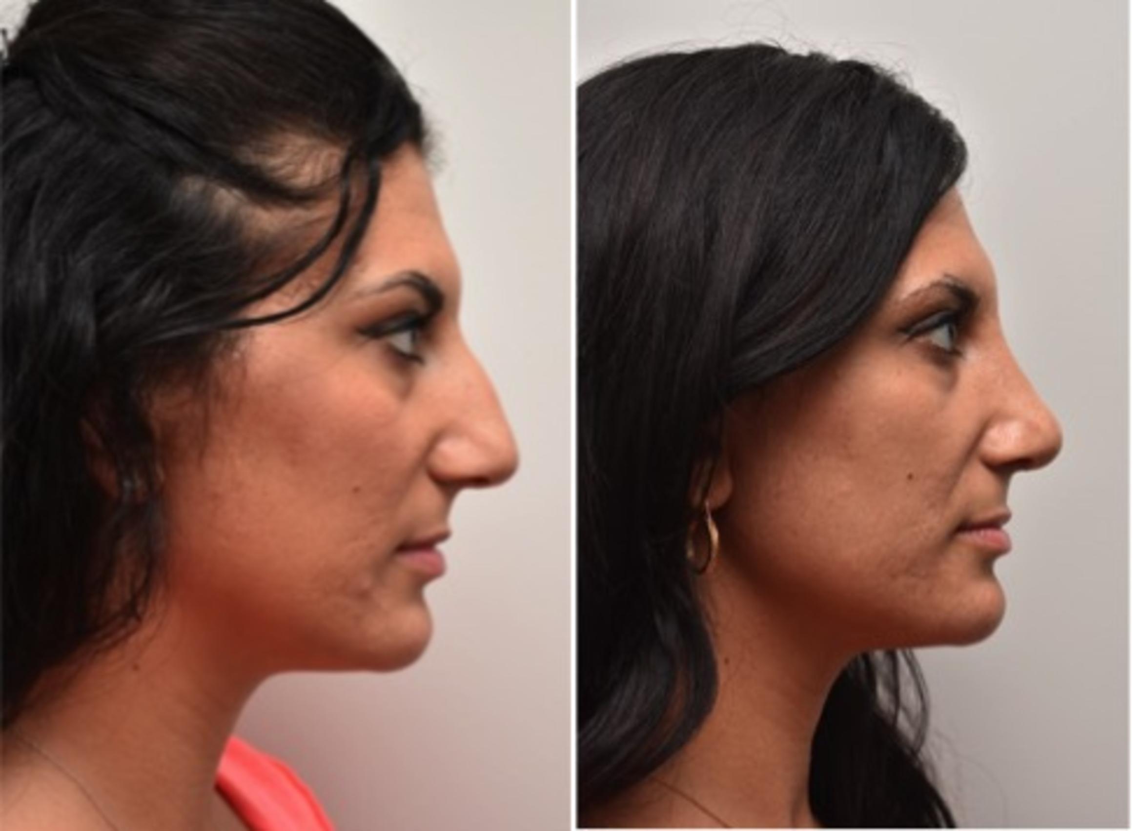 Before & After Rhinoplasty Case 294 View #5 View in Albany & Latham, New York
