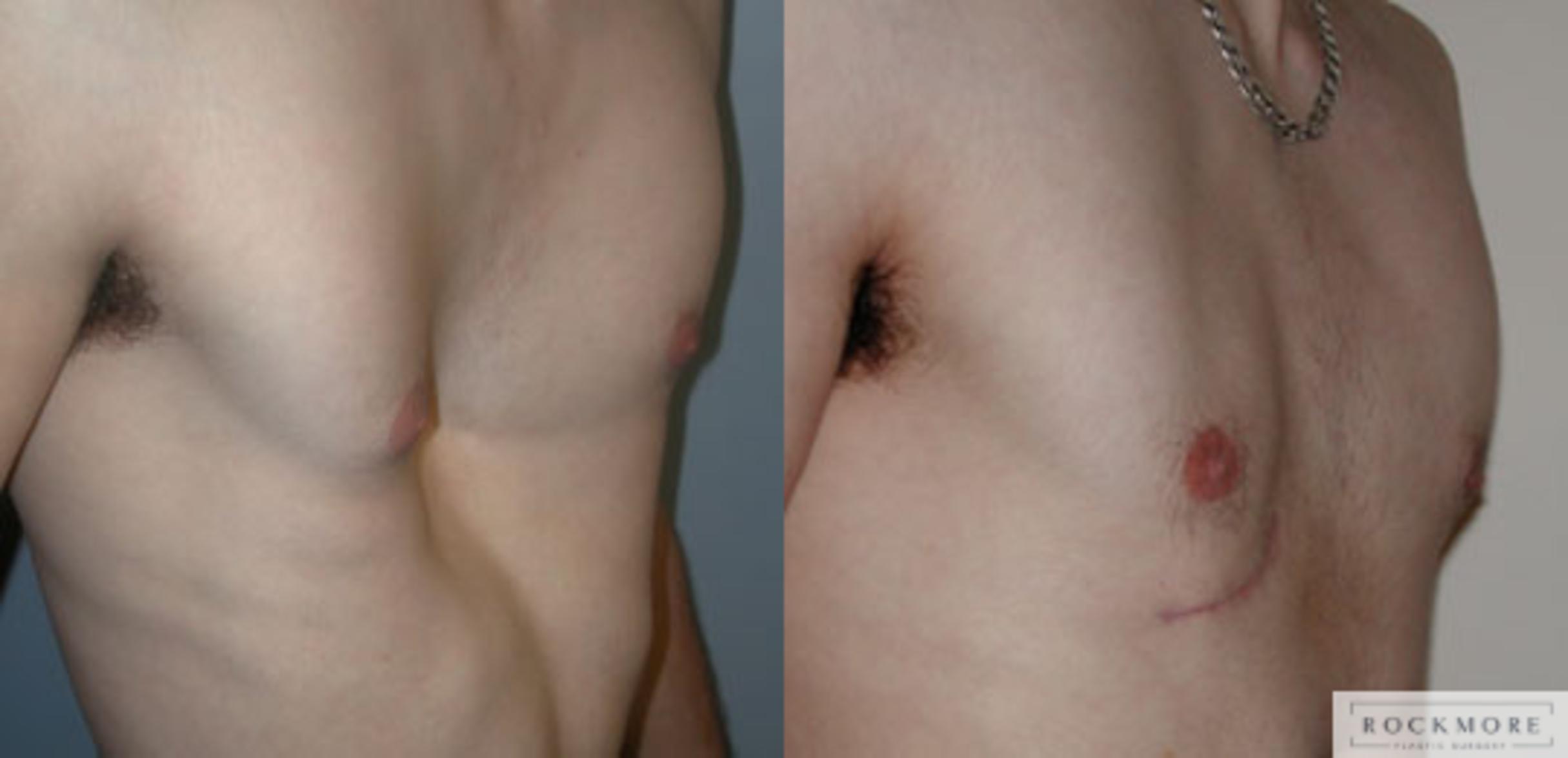 Before & After Pectus Excavatum Case 39 View #1 View in Albany & Latham, New York