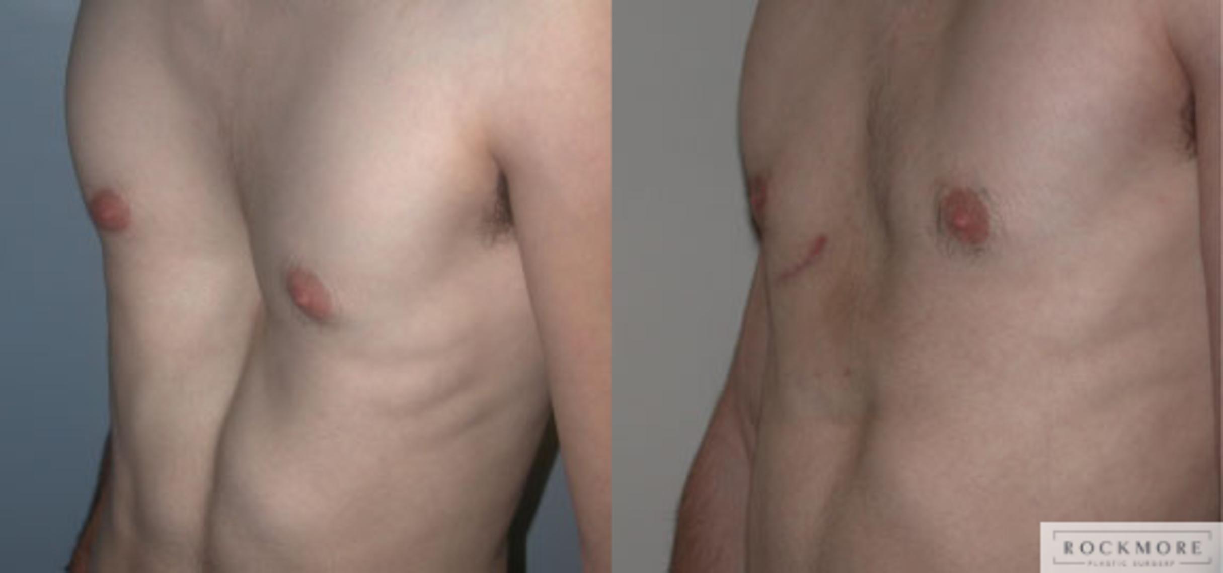 Before & After Pectus Excavatum Case 39 View #2 View in Albany & Latham, New York