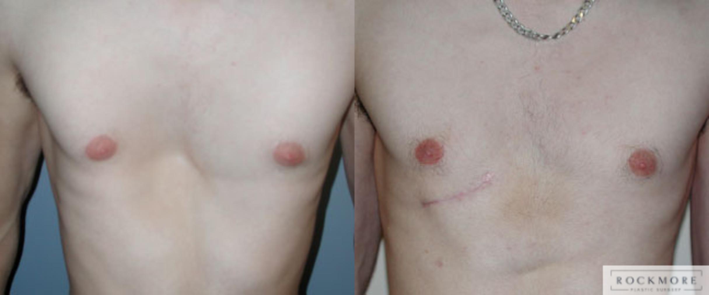 Before & After Pectus Excavatum Case 39 View #3 View in Albany & Latham, New York