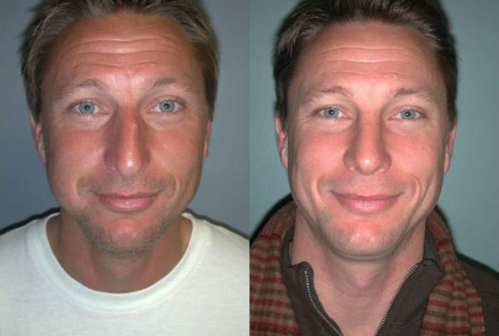 Before & After Rhinoplasty Case 113 View #1 View in Albany, Latham & Saratoga, New York