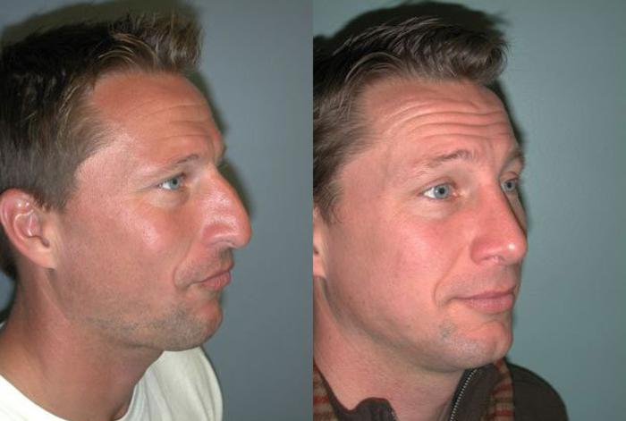 Before & After Rhinoplasty Case 113 View #2 View in Albany, Latham & Saratoga, New York