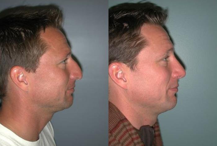 Before & After Rhinoplasty Case 113 View #3 View in Albany, Latham & Saratoga, New York