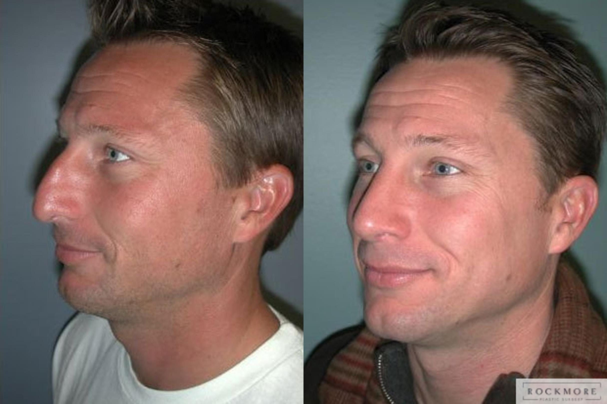 Before & After Rhinoplasty Case 113 View #4 View in Albany & Latham, New York