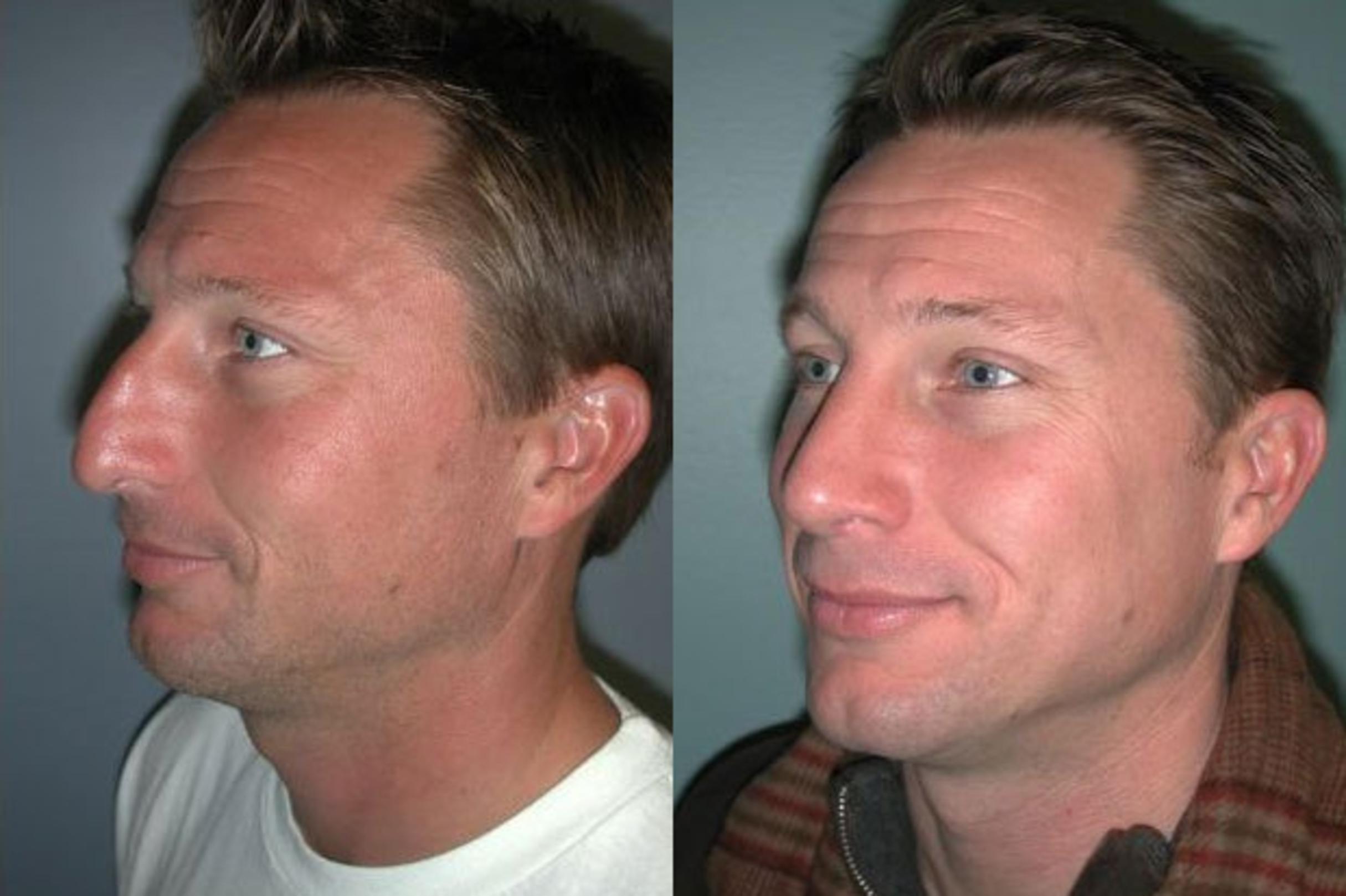 Before & After Rhinoplasty Case 113 View #4 View in Albany & Latham, New York