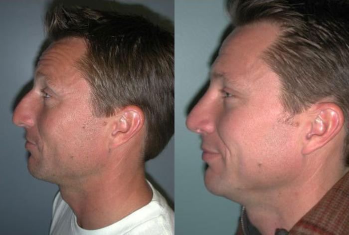 Before & After Rhinoplasty Case 113 View #5 View in Albany, Latham & Saratoga, New York