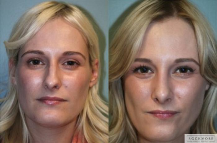 Before & After Rhinoplasty Case 127 View #1 View in Albany, Latham & Saratoga, New York