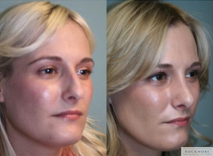 Before & After Rhinoplasty Case 127 View #2 View in Albany, Latham & Saratoga, New York