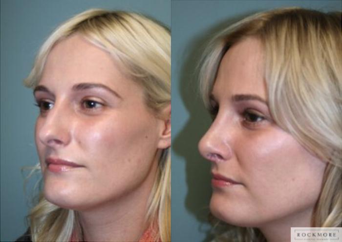 Before & After Rhinoplasty Case 127 View #3 View in Albany, Latham & Saratoga, New York