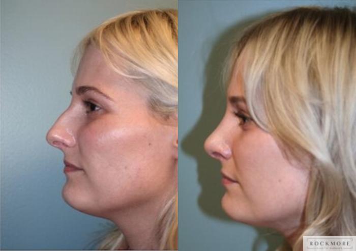 Before & After Rhinoplasty Case 127 View #4 View in Albany, Latham & Saratoga, New York