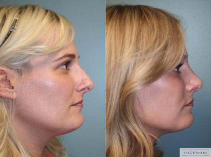 Before & After Rhinoplasty Case 127 View #5 View in Albany, Latham & Saratoga, New York