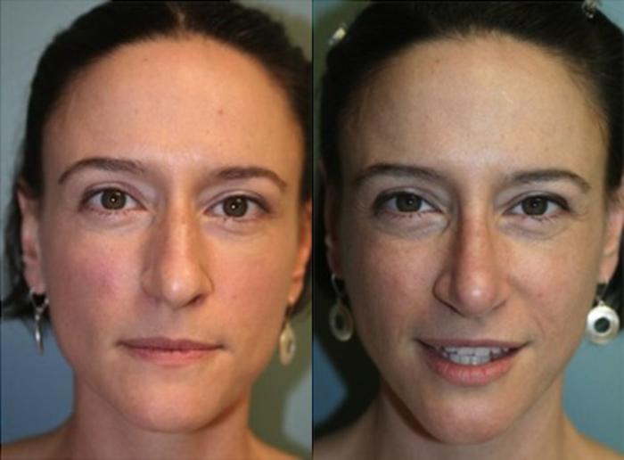 Before & After Rhinoplasty Case 128 View #1 View in Albany, Latham & Saratoga, New York