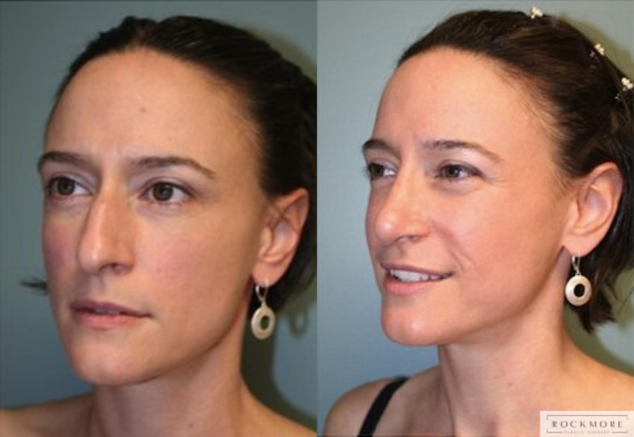Before & After Rhinoplasty Case 128 View #2 View in Albany & Latham, New York
