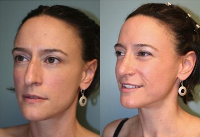 Before & After Rhinoplasty Case 128 View #2 View in Albany, Latham & Saratoga, New York