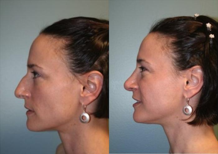 Before & After Rhinoplasty Case 128 View #3 View in Albany, Latham & Saratoga, New York