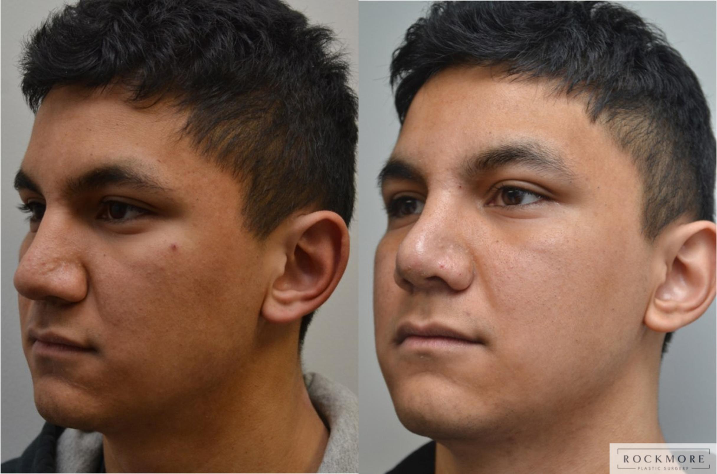 Before & After Rhinoplasty Case 195 View #2 View in Albany & Latham, New York