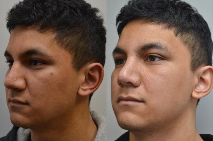 Before & After Rhinoplasty Case 195 View #2 View in Albany, Latham & Saratoga, New York