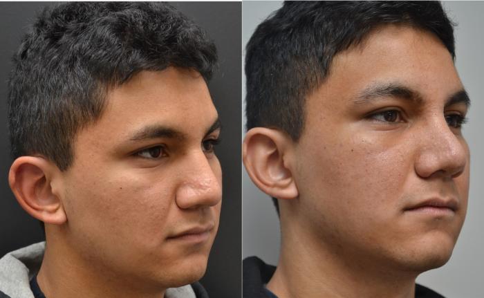 Before & After Rhinoplasty Case 195 View #3 View in Albany, Latham & Saratoga, New York