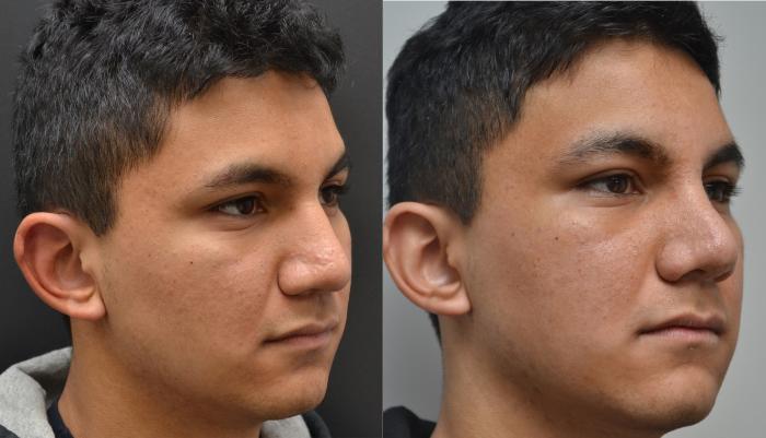 Before & After Rhinoplasty Case 195 View #4 View in Albany, Latham & Saratoga, New York