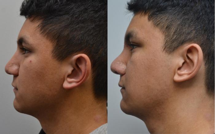 Before & After Rhinoplasty Case 195 View #5 View in Albany, Latham & Saratoga, New York