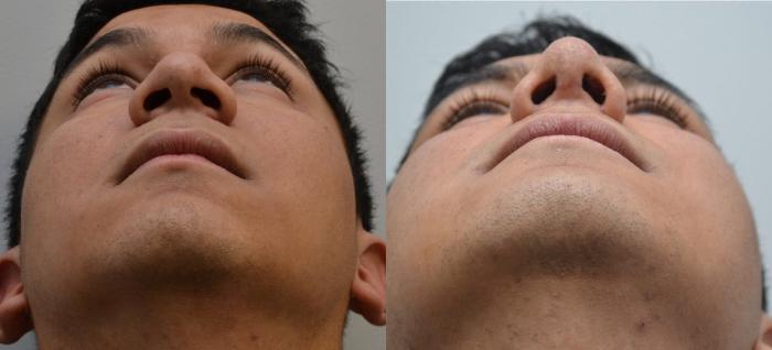 Before & After Rhinoplasty Case 195 View #6 View in Albany, Latham & Saratoga, New York