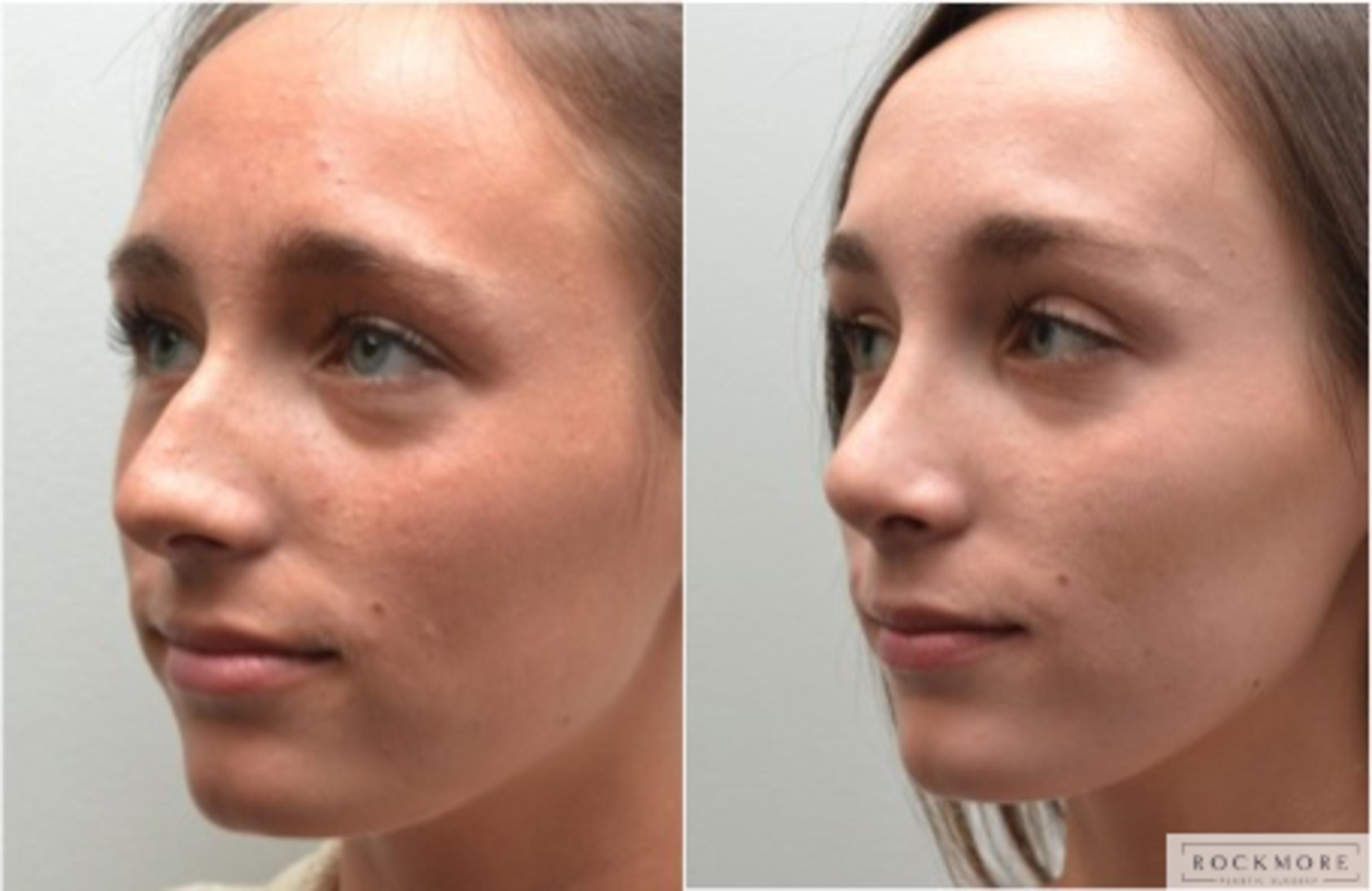 Before & After Rhinoplasty Case 204 View #1 View in Albany, Latham & Saratoga, New York