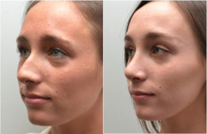 Before & After Rhinoplasty Case 204 View #1 View in Albany, Latham & Saratoga, New York