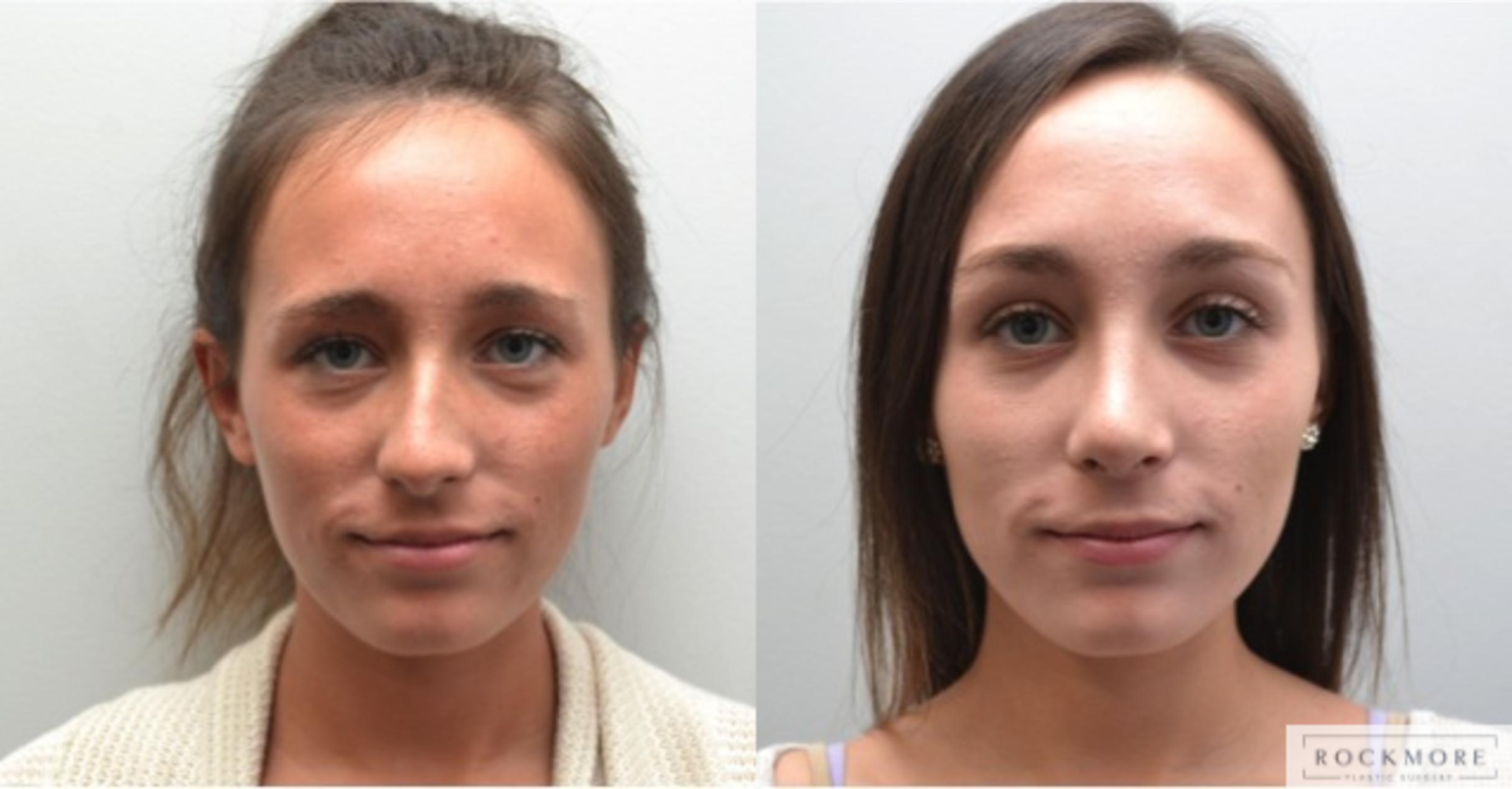 Before & After Rhinoplasty Case 204 View #2 View in Albany, Latham & Saratoga, New York