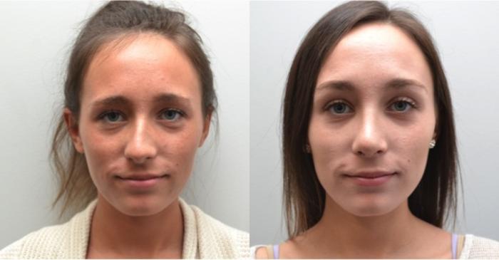 Before & After Rhinoplasty Case 204 View #2 View in Albany, Latham & Saratoga, New York