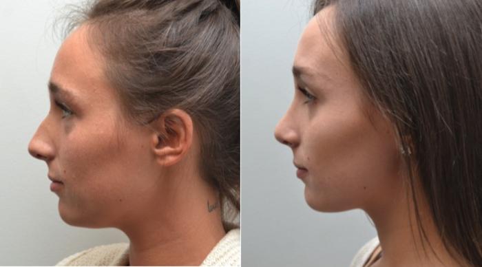 Before & After Rhinoplasty Case 204 View #4 View in Albany, Latham & Saratoga, New York