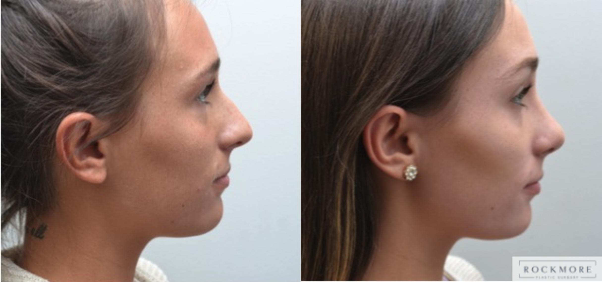 Before & After Rhinoplasty Case 204 View #5 View in Albany, Latham & Saratoga, New York