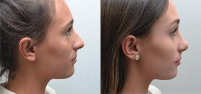 Before & After Rhinoplasty Case 204 View #5 View in Albany, Latham & Saratoga, New York