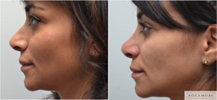 Before & After Rhinoplasty Case 208 View #2 View in Albany & Latham, New York