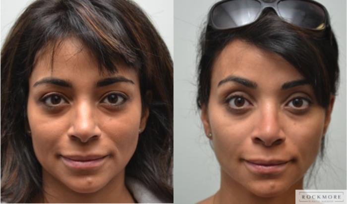 Before & After Rhinoplasty Case 208 View #3 View in Albany & Latham, New York