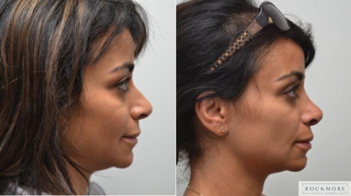 Before & After Rhinoplasty Case 208 View #5 View in Albany & Latham, New York