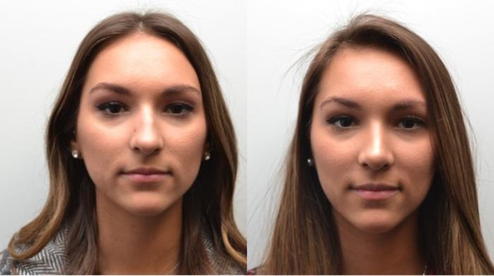 Before & After Rhinoplasty Case 239 View #1 View in Albany, Latham & Saratoga, New York