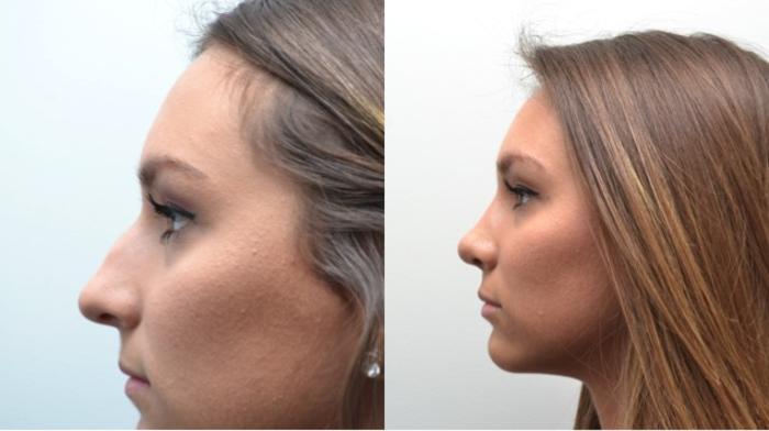 Before & After Rhinoplasty Case 239 View #2 View in Albany, Latham & Saratoga, New York