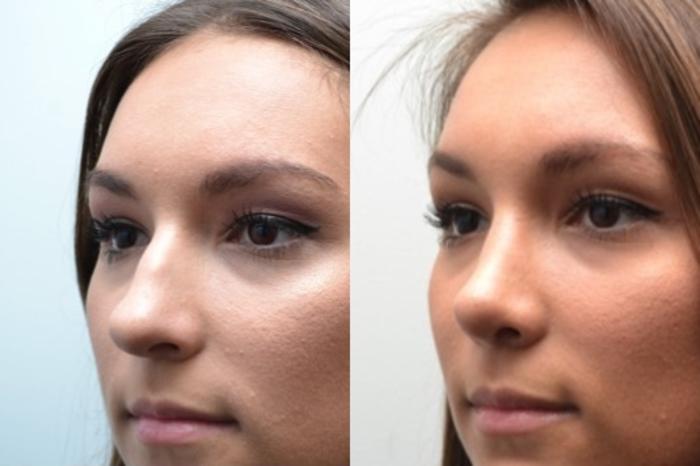 Before & After Rhinoplasty Case 239 View #4 View in Albany, Latham & Saratoga, New York