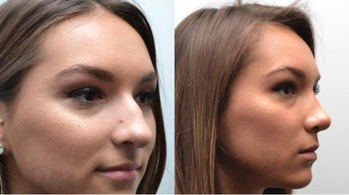 Before & After Rhinoplasty Case 239 View #5 View in Albany, Latham & Saratoga, New York