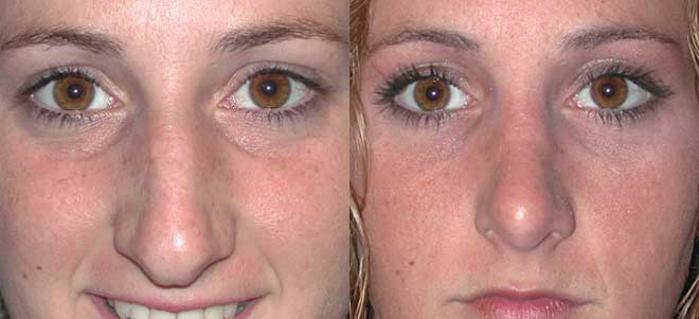 Before & After Rhinoplasty Case 26 View #1 View in Albany, Latham & Saratoga, New York