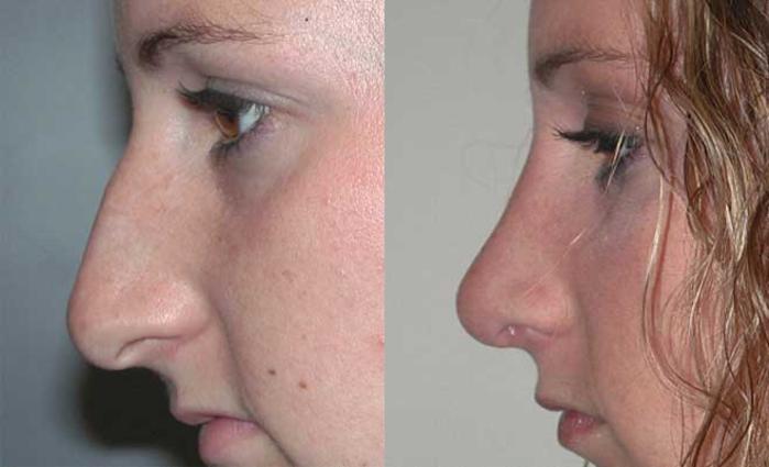 Before & After Rhinoplasty Case 26 View #2 View in Albany, Latham & Saratoga, New York