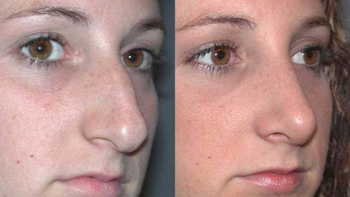 Before & After Rhinoplasty Case 26 View #3 View in Albany, Latham & Saratoga, New York