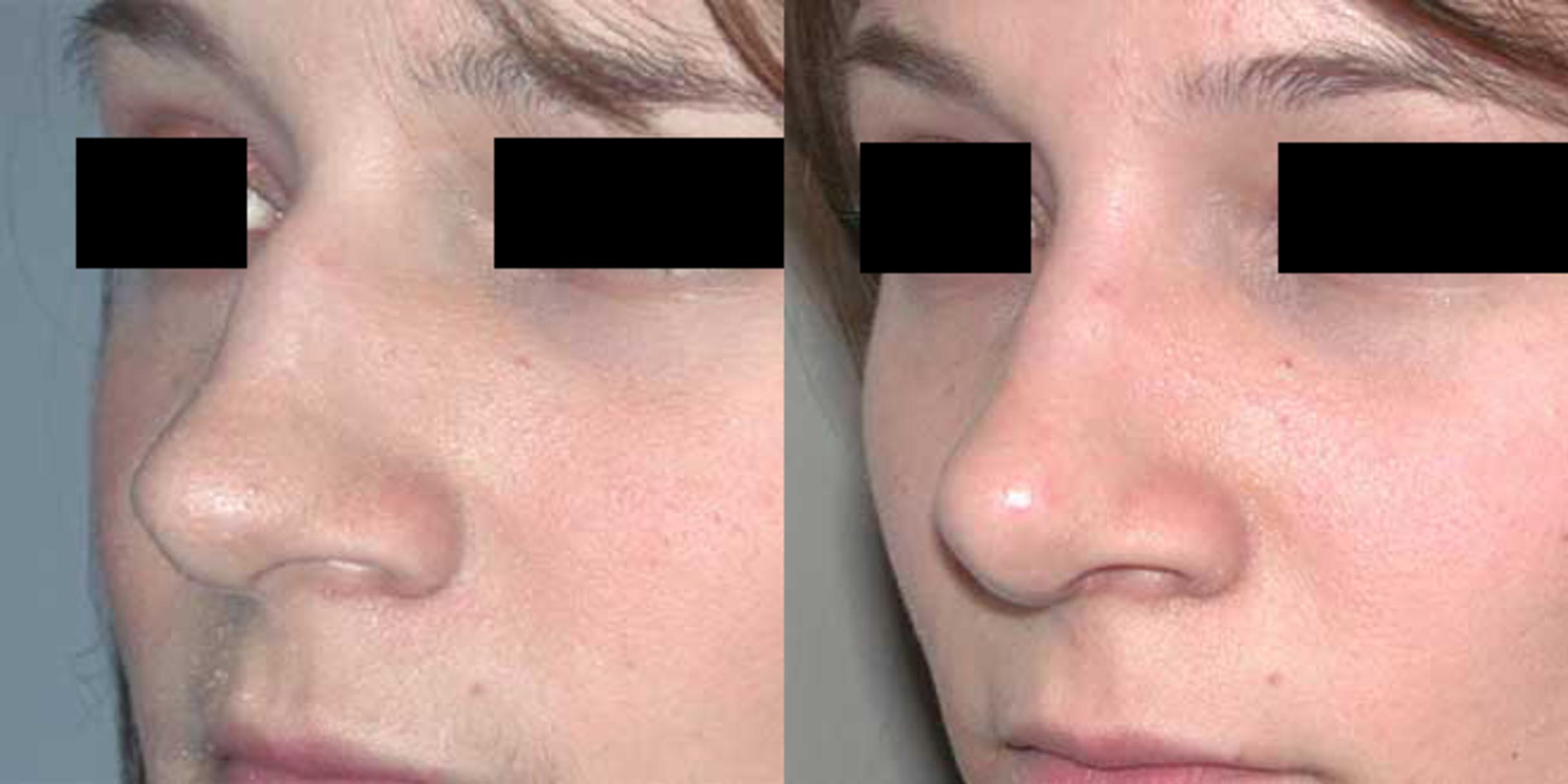 Before & After Rhinoplasty Case 27 View #2 View in Albany, Latham & Saratoga, New York