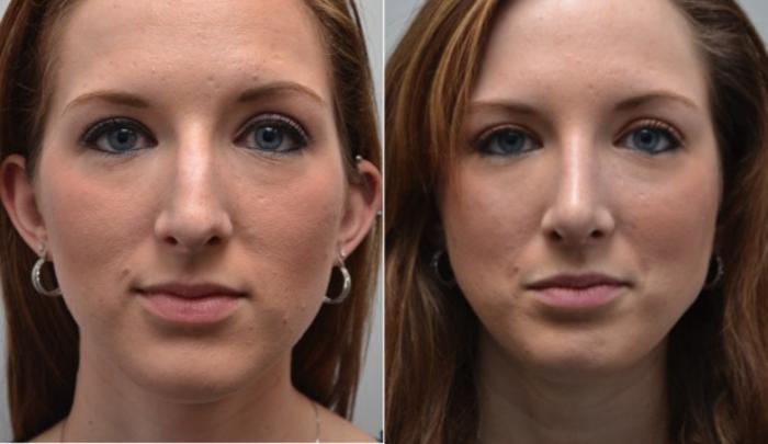 Before & After Rhinoplasty Case 272 View #1 View in Albany, Latham & Saratoga, New York