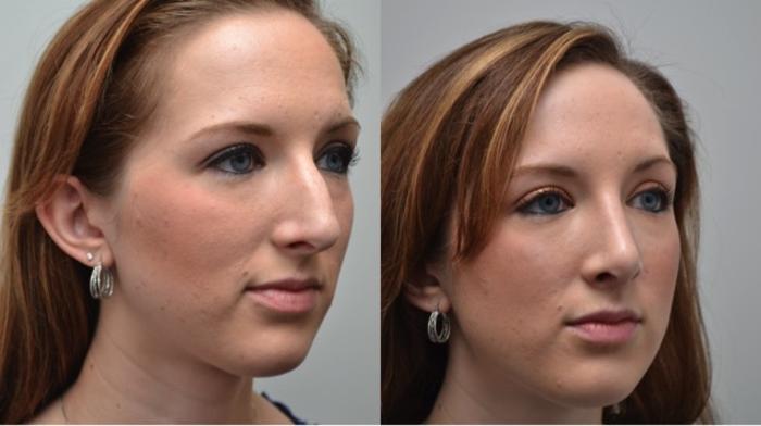 Before & After Rhinoplasty Case 272 View #2 View in Albany, Latham & Saratoga, New York