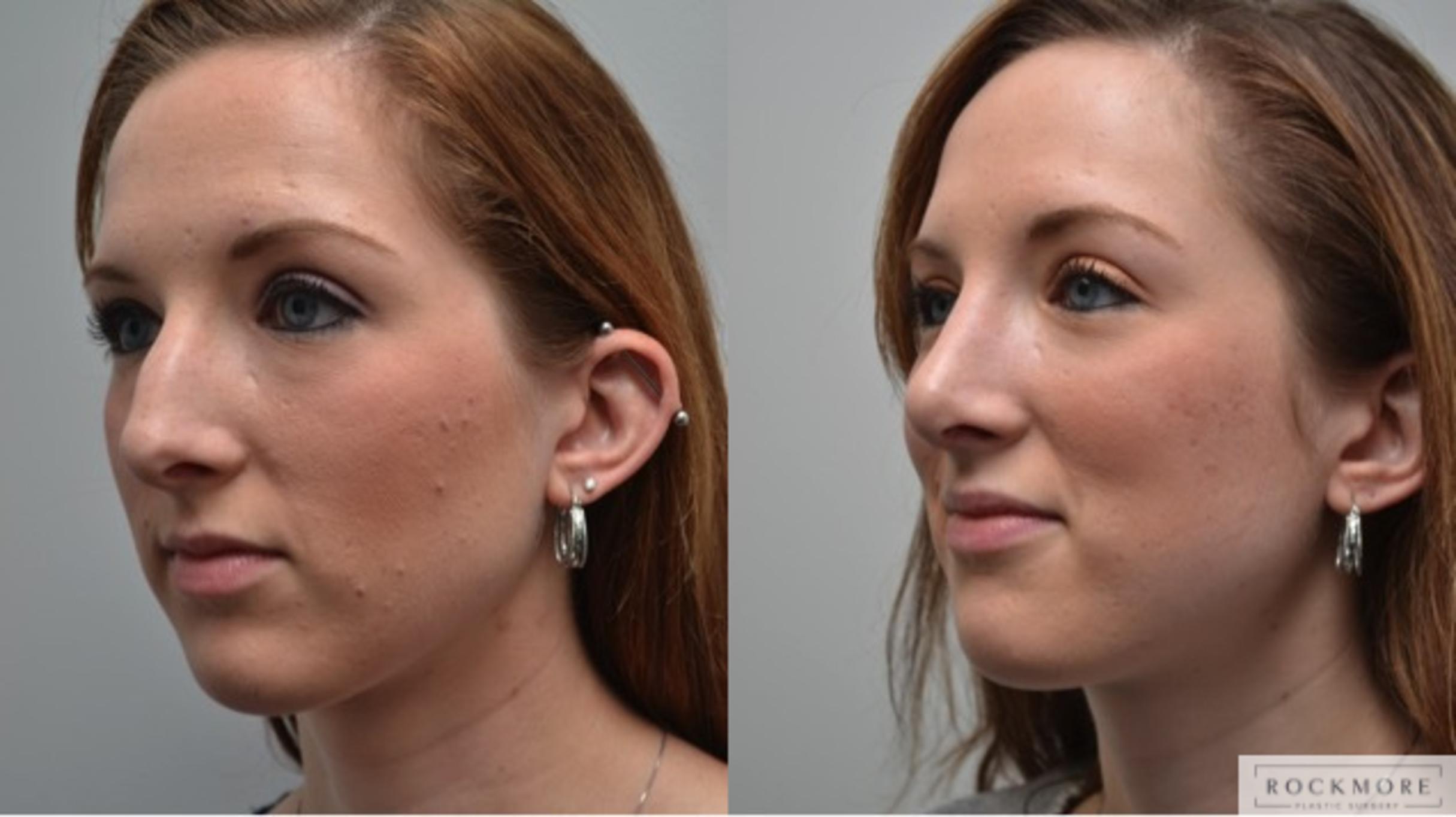 Before & After Rhinoplasty Case 272 View #3 View in Albany & Latham, New York
