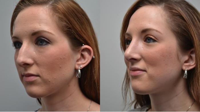 Before & After Rhinoplasty Case 272 View #3 View in Albany, Latham & Saratoga, New York