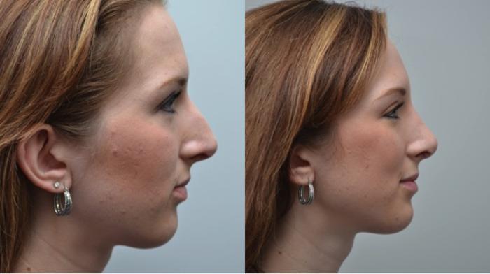 Before & After Rhinoplasty Case 272 View #4 View in Albany, Latham & Saratoga, New York