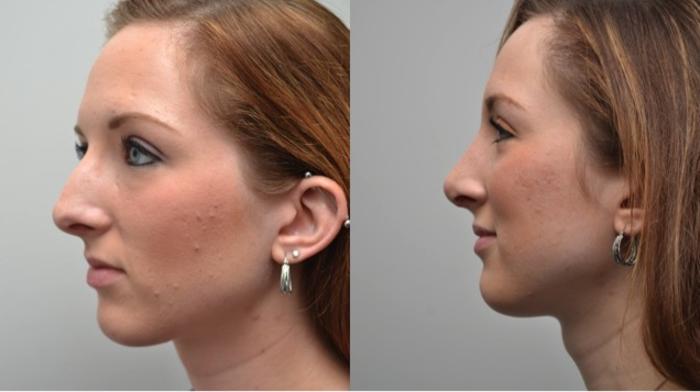 Before & After Rhinoplasty Case 272 View #5 View in Albany, Latham & Saratoga, New York