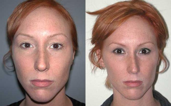 Before & After Rhinoplasty Case 28 View #1 View in Albany, Latham & Saratoga, New York